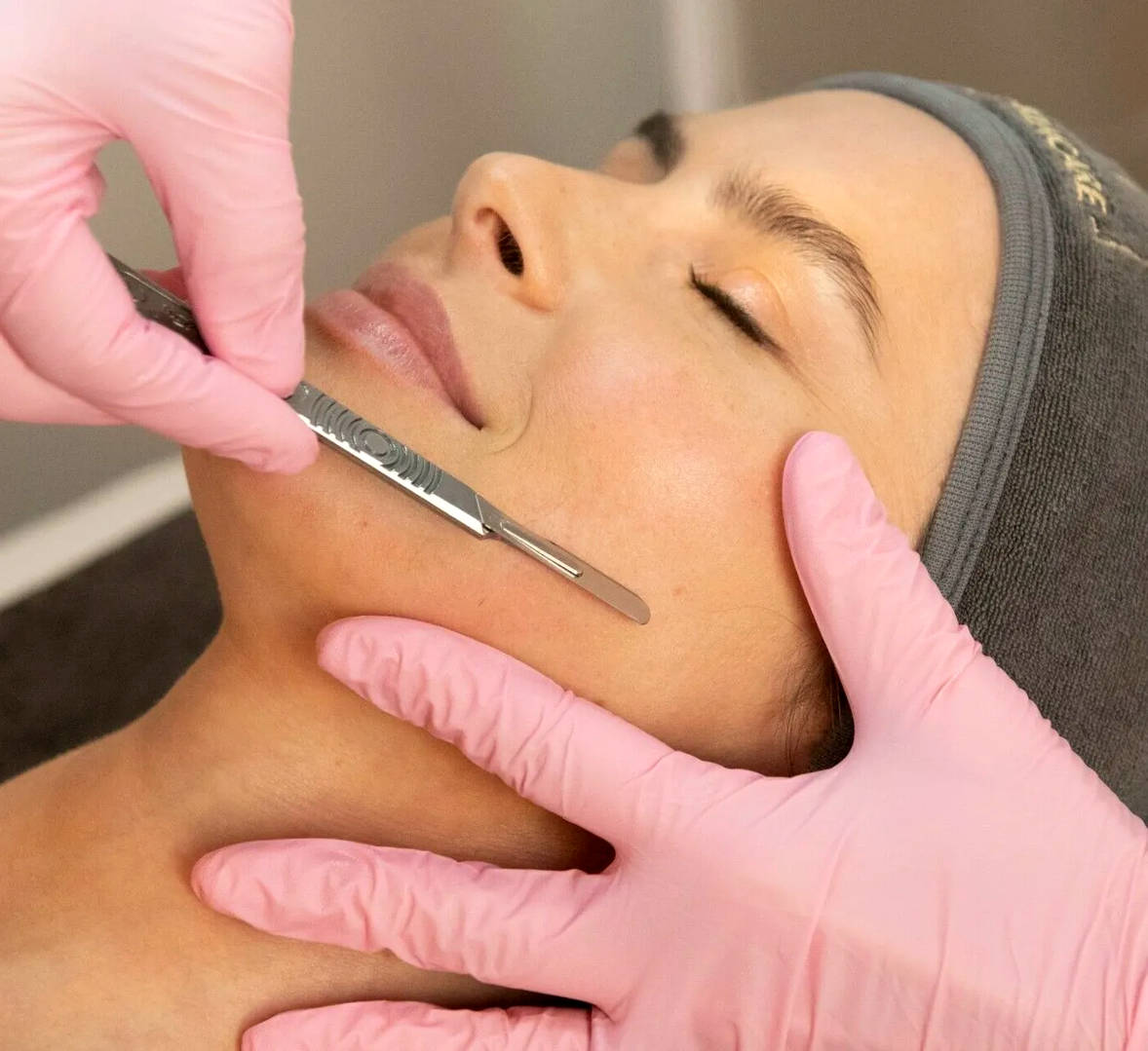 Dermaplaning to zabieg kosmetyczny